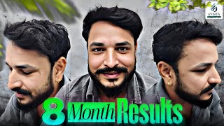 Hair transplant in jabalpur | Amazing Hair Transplant Journey | Best Hair Transplant Result | Avista