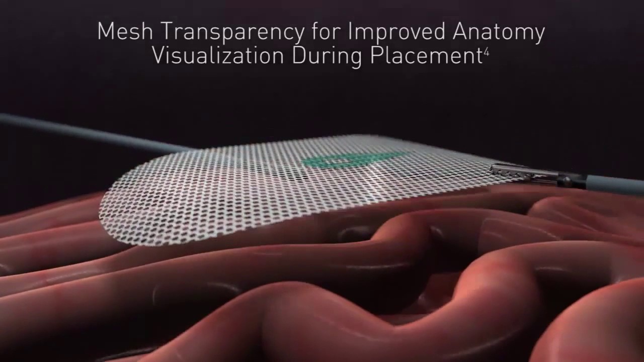 Laparoscopic Ventral Hernia Repair Overcoming Incisional