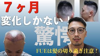 【自毛植毛７ヶ月】若ハゲ脱却！！圧倒的変化を実感中！！ヘアカットしたよ！