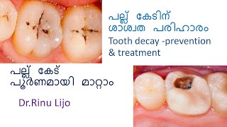 പല്ലു കേടിന്  പരിഹാരമാർഗങ്ങൾ (Tooth decay, prevention and treatment)