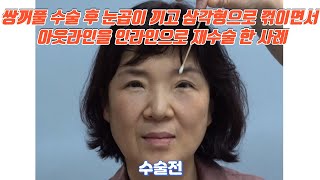 쌍꺼풀 수술 후 눈곱이 끼고 삼각형으로 꺾이면서 아웃라인을 인라인으로 재수술 한 사례