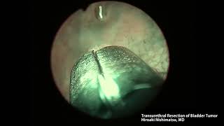 Transurethral Resection of the Bladder Tumor