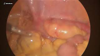 10032021 Laparoscopic Appendectomy for Acute Plastron Appendicitis 1252