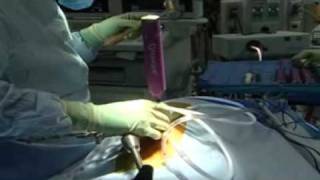 XLIF® Procedure- Minimally Disruptive Procedure for Spine Surgery