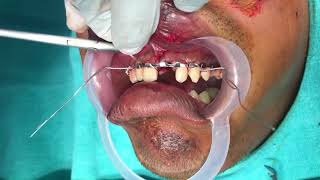 Arch Bar Fixation for Maxillary Dentoalveolar Fracture - Dr Sunil Richardson