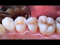 Dr Anthony Tay - Tokuyama Estelite Sigma Quick Posterior Single Shade Composites