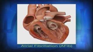 Atrial Fibrillation May Lead to Serious Health Issues