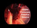 Massive Saddle Pulmonary Embolism Removal Whole procedure - Embolectomy