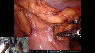 Robotic Extended Right Hemi with intracorporeal isoperistaltic anastomosis