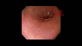 Duodenitis