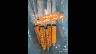 Breast Enlargement using fat transfer from abdomen