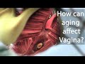 How can aging affect Vagina?