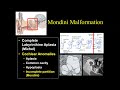 Suresh Mukherji.  Pre-op Imaging of Cochlear Implants