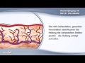 fraktionierte hautverjüngung mit dem erbium laser mcl31 dermablate von asclepion