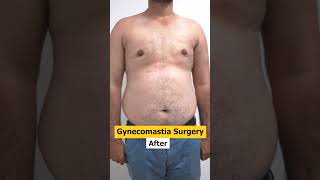 Gynecomastia Surgery result | Manboobs Surgery #shorts