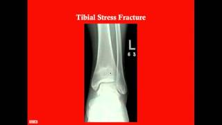 Distal Lower Extremity - CRASH! Medical Review Series