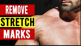 How To Get Rid Of Stretch Marks | কিভাবে গায়ের ফাটা দাগ দূর করবেন?