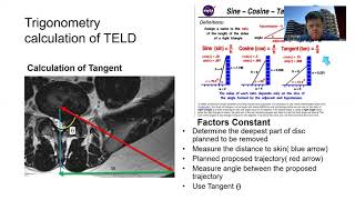 Transforaminal Lumbar Endoscopic Discectomy Tutorial ASEAN Minimally Invasive Spine Surgery Society