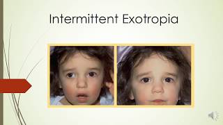 CONCOMITANT EXOTROPIA