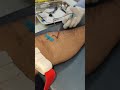 How to Draw a Blood Sample with Butterfly Needle?