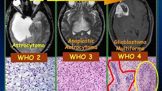 MedPix Video - Diffuse Gliomas