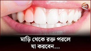 মাড়ি ফুলে যাচ্ছে বা মাড়ি থেকে রক্ত পরছে? কি করবেন? | Oral Gum Infection | Oral Health | Channel 24