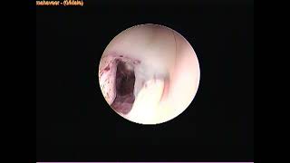 MPJ ETV and Aqueductoplasty