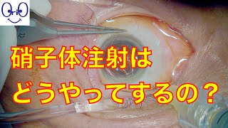 硝子体注射（抗VEGF抗体）の仕方　Intravitreal injection of anti-VEGF