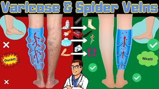 Spider Veins in Legs & Varicose Veins Treatment [Causes & Symptoms]