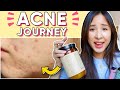 How I Used Food, Supplements & Nutrition to CLEAR My Acne, NATURALLY 😍