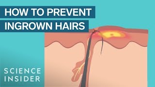 What Are Ingrown Hairs — And How To Treat Them