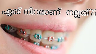 Tricks for selecting braces colour/  pallil kambi idunnath/ braces / pallil kambi / kambi /dr athira