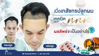 เมื่อเภสัชกรปลูกผมเทคนิค NNN ผลลัพธ์จะเป็นอย่างไร?