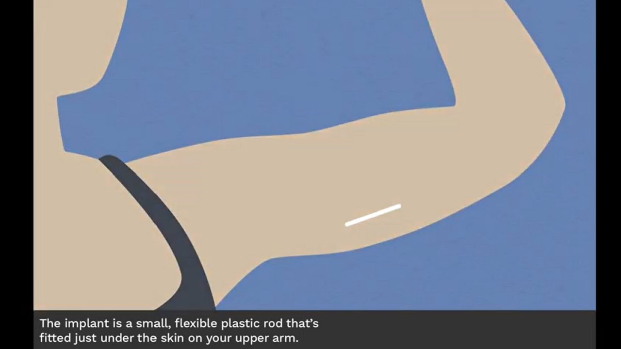 Implant Youtube