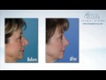 dramatic revision rhinoplasty before and after dallas texas