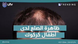 ظاهرة الصلع لدى صغار قرية الكيف في كركوك | #UTrending