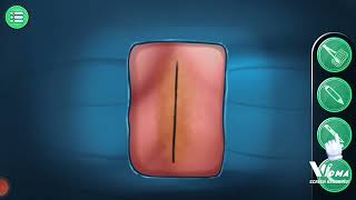 SURGERY OF SOLIOSIS animation 3D