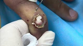 手指黏液囊腫以電燒切除 美麗新城診所莊禮謙醫師 Mucous Cyst Excision, Cauterization, Dr George