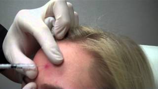 Cystic Acne Treatment (Kenalog Steriod Injection) with Dr. Seiler