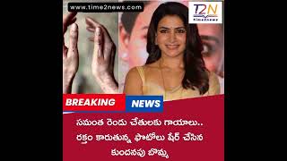 Samantha | సమంత రెండు చేతులకు గాయాలు.. రక్తం కారుతున్న ఫొటోలు షేర్ చేసిన కుందనపు బొమ్మ #samantha