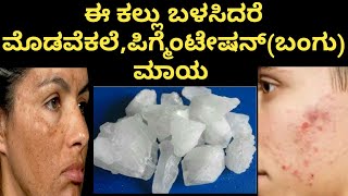 ಈ ಕಲ್ಲನ್ನ ಬಳಸಿದ್ದೀರಾ? | How to Remove Pigmentation, Dark Spots \u0026 Pimple Marks | Kannada Beauty Tips