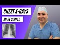 Chest x-rays made simple - Interpreting chest x-rays for medical students