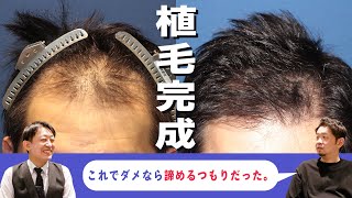 【植毛手術1年後】30代男性が生え際と前頭部のお悩み解消で大変身！？〜前編〜【自毛植毛】【薄毛】