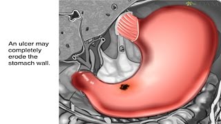 How Stomach Ulcers Form Animation - Peptic Ulcer Disease: Causes, Symptoms and Treatments Video