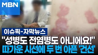 [자막뉴스] ＂성병도 전염병도 아니에요!＂ 따가운 시선에 두 번 아픈 '건선' | 이슈픽