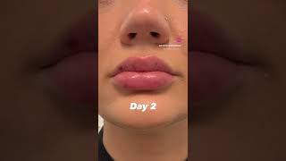 Lip Filler Progress Photos