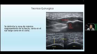 Footexperts 2023 Dr. Gustavo Lucar Fasciotomia longitudinal ecoguiada para fascitis plantar.