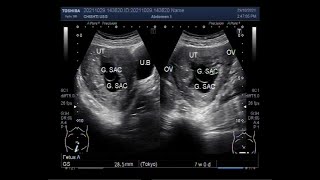 Seven weeks of Twin Pregnancy with both Blighted Ova is also called Anembryonic pregnancies.