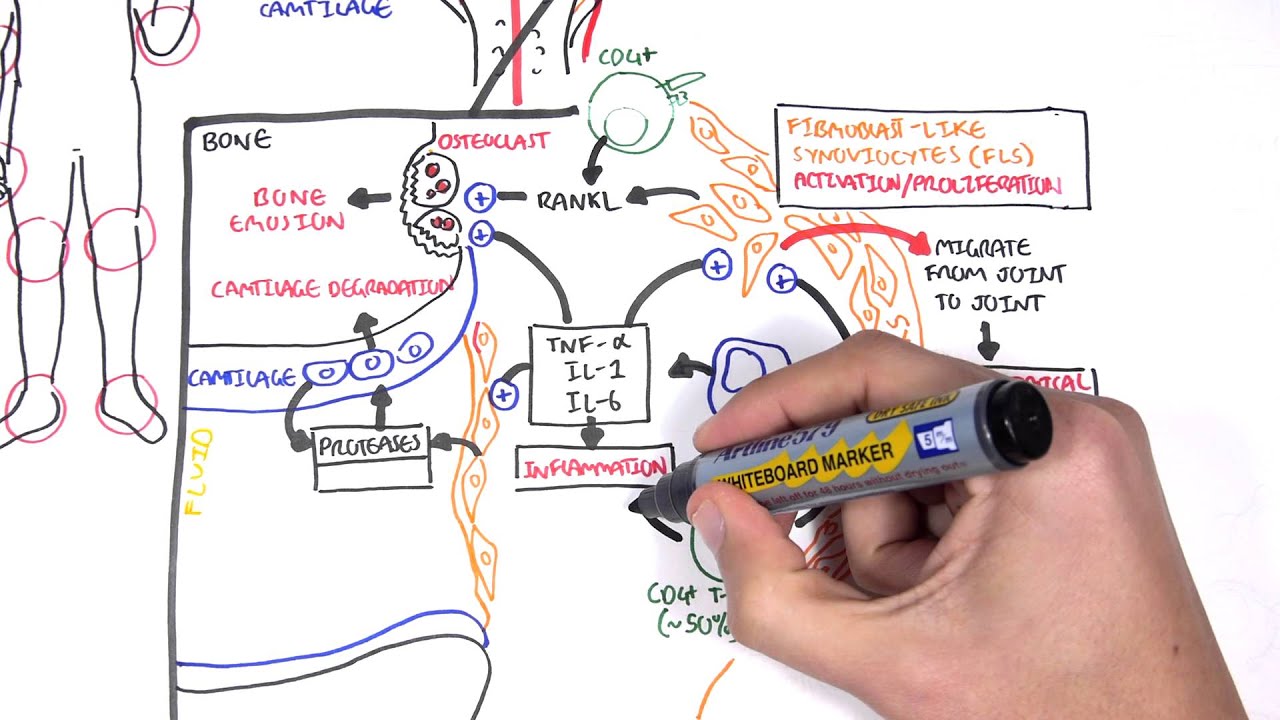 Rheumatoid Arthritis Diagram