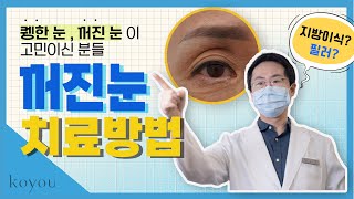 고유성형외과 꺼진눈 퀭한눈 꺼진 눈이 고민이신 분들 봐주세요.